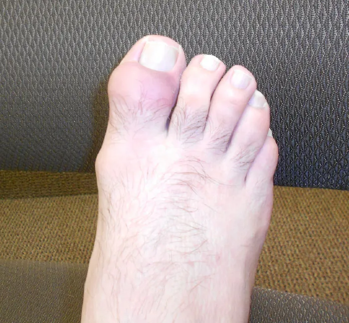 The image shows a close-up of a bare foot with noticeable swelling around the base of the big toe, suggesting gout. The foot is resting against a textured black background, likely a chair or a bench.