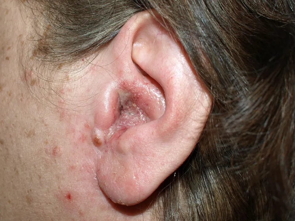 External otitis