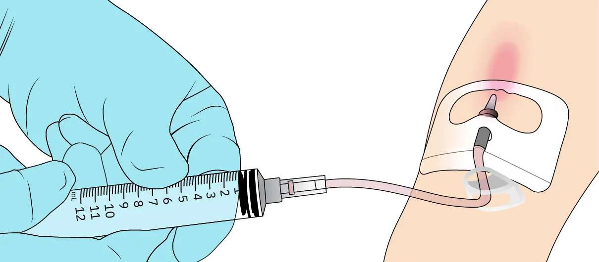 An illustration shows a person’s arm and two gloved hands using a syringe. There is a tube from the syringe to the arm, and redness at the site of injection.
