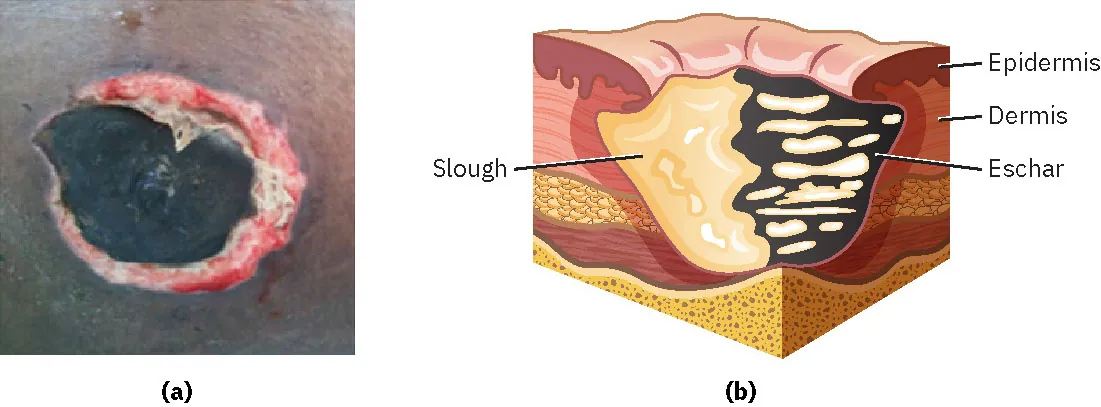 A color diagram of the skin showing the presence of both eschar and slough. The injury is far below the dermis and is unstageable.