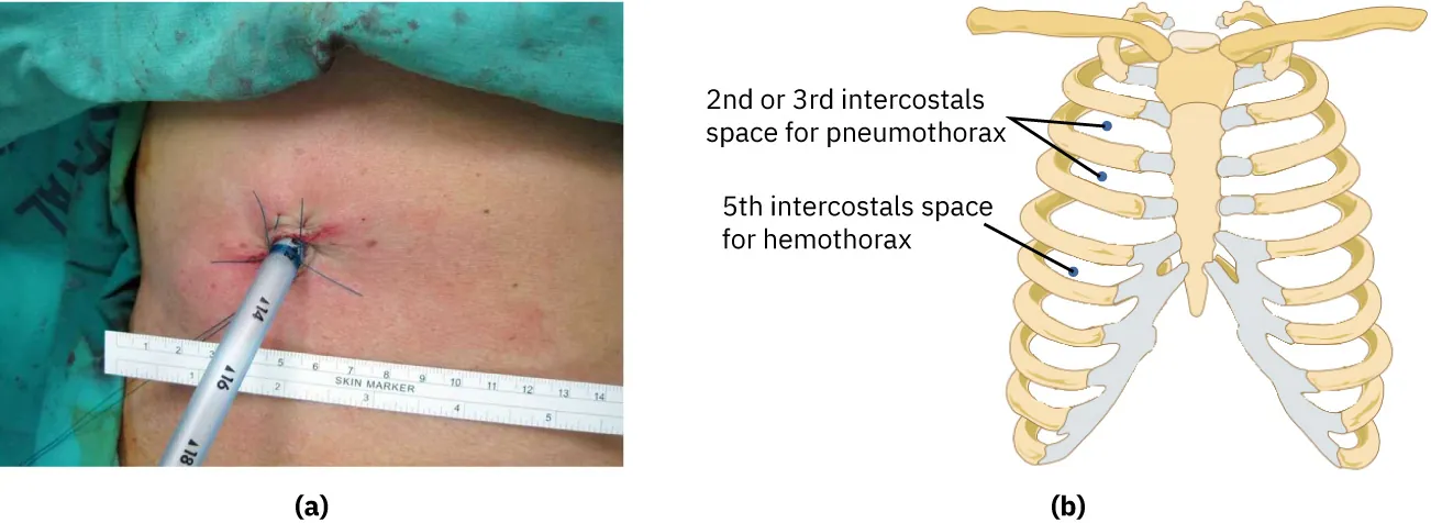 Images showing where to place chest drainage tubes depending on the objective.