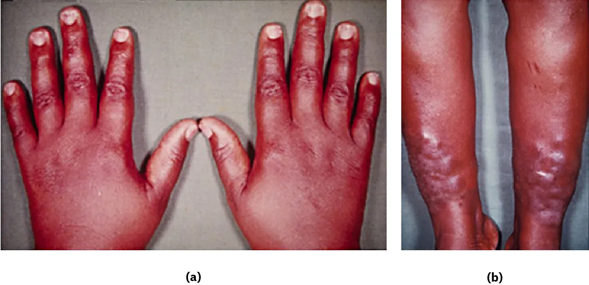 Two images showing (a) hands and (b) legs with myexedema.