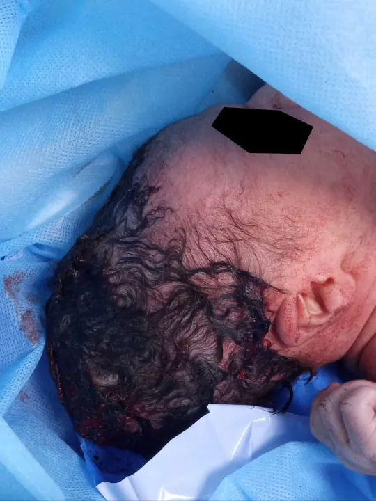 Photo of newborn with elongated head.