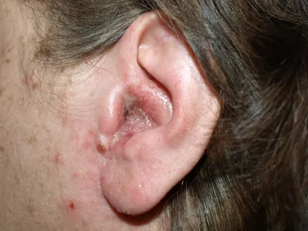 A photograph of a woman's ear with swimmer's ear. It shows infection that has left the outer ear deformed and swollen.