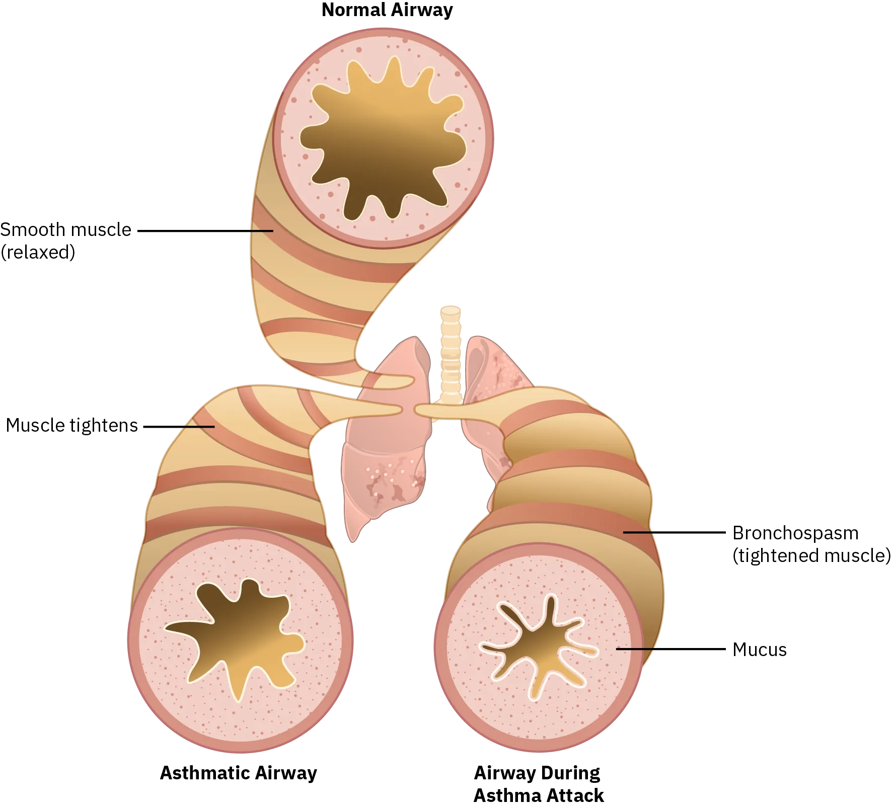 Diagram of a normal airway and an asthmatic airway. In a normal airway, the airway is wide open and the smooth muscle is relaxed. In an asthmatic airway, the muscle tightens and the airway is not as wide open. In an airway during an asthma attack, there is a bronchospasm, or tightened muscle, and mucus fills the already restricted space of the airway.