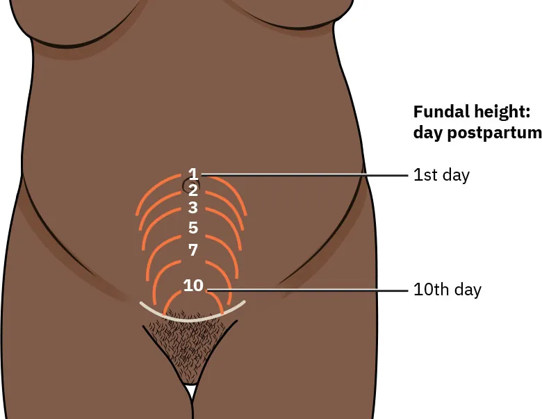 Image of the fundal height on an abdomen from the 1st day postpartum (higher on the abdomen) to the 10th day postpartum (lower on the abdomen).