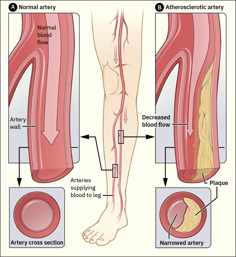 A diagram showing the difference between a normal artery and an atherosclerotic artery.
