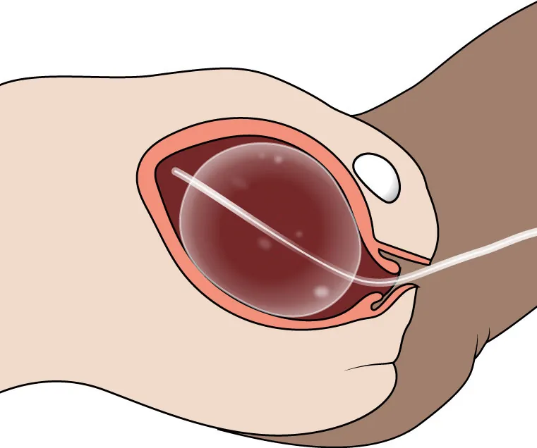 Diagram showing Bakri Balloon being inserted into the uterus.