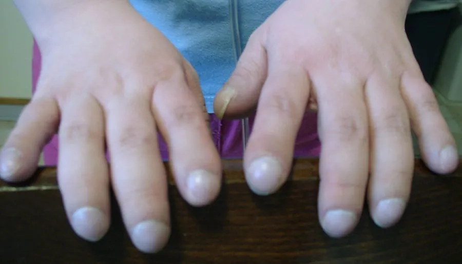 A color photograph shows two swollen hands and fingers.