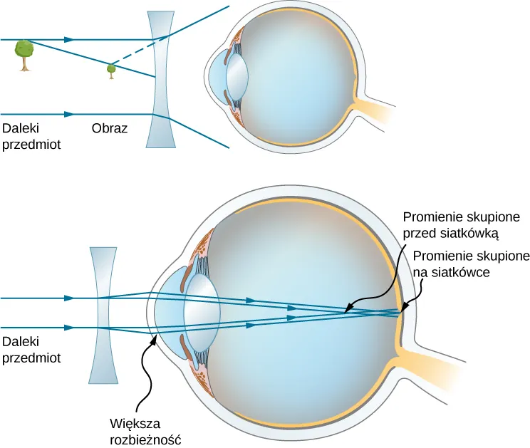 Figura pokazuje dwa schematy ludzkiego oka, przed którym znajduje się soczewka dwuwklęsła. Pierwszy schemat przedstawia drzewo jako odległy przedmiot oraz obraz drzewa znajdujący się bliżej soczewki. Drugi schemat przedstawia równoległe promienie biegnące od odległego przedmiotu shows padające na soczewkę i ulegające odchyleniu, a następnie padające na rogówkę. Następnie promienie skupiają się na siatkówce.