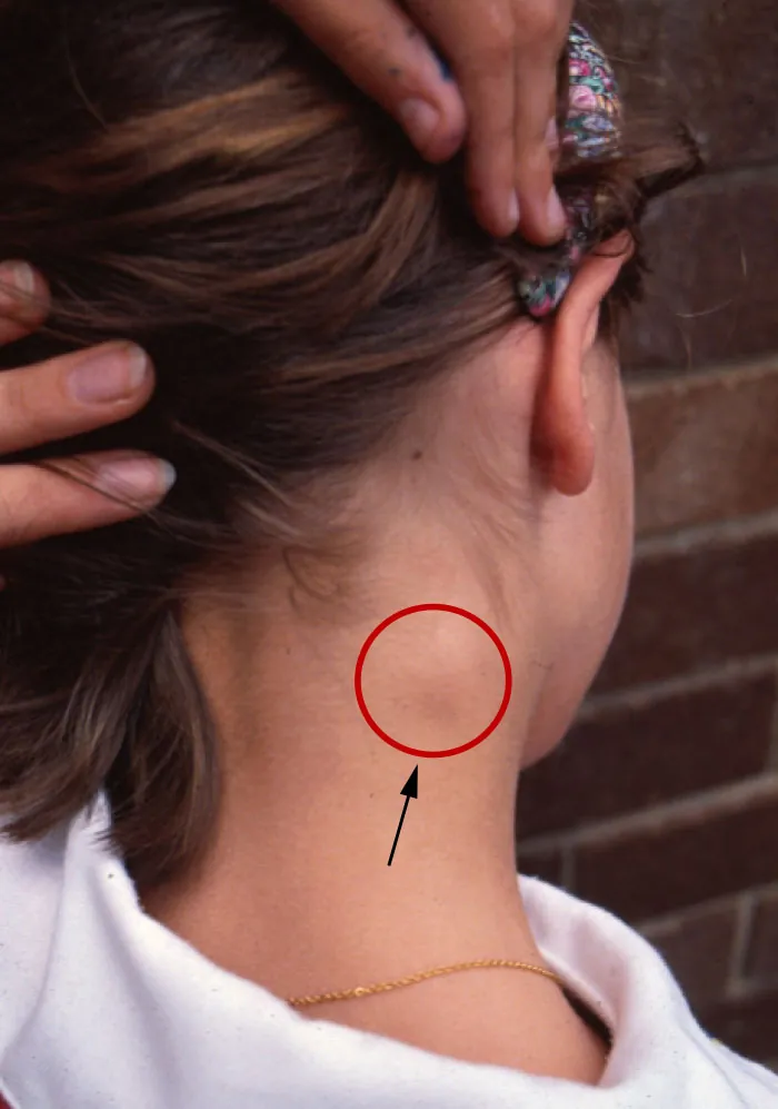 A color photograph shows a woman’s neck with a circle around a lump on her upper neck.