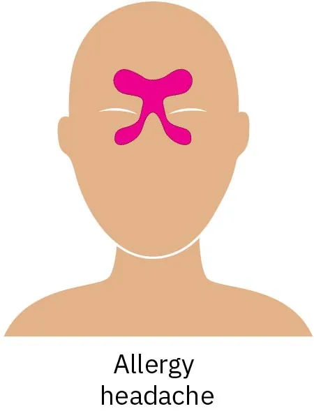 A drawing of a person’s face with a pink highlight on the central forehead and upper nose area, showing where pain caused by allergy is reflected.
