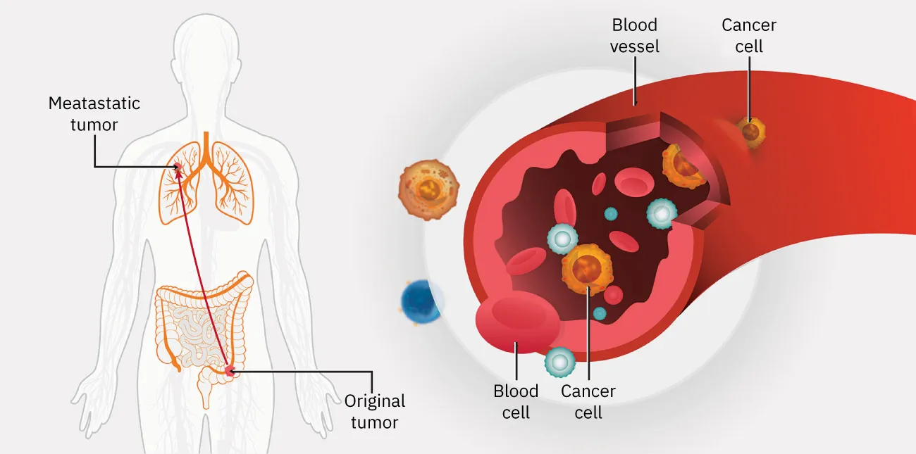 Diagram of body showing original tumor in intestine and metastatic tumor in lung; diagram of blood vessel showing cancer cells and blood cells