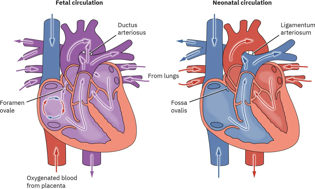 Diagram showing fetal circulation (labeling ductus arteriosus, foramen ovale, oxygenated blood from placenta, and blood from lungs) and neonatal circulation (labeling ligamentum arteriosum, fossa ovalis, and blood from lungs)