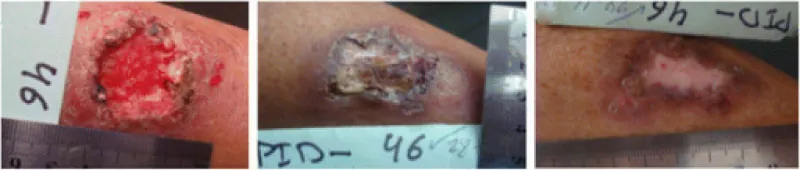 Images showing epithelialization.