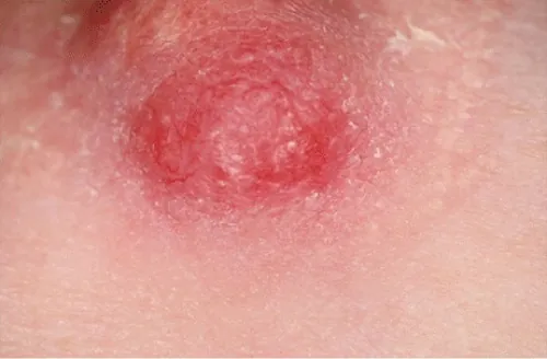 An image showing an example of induration.