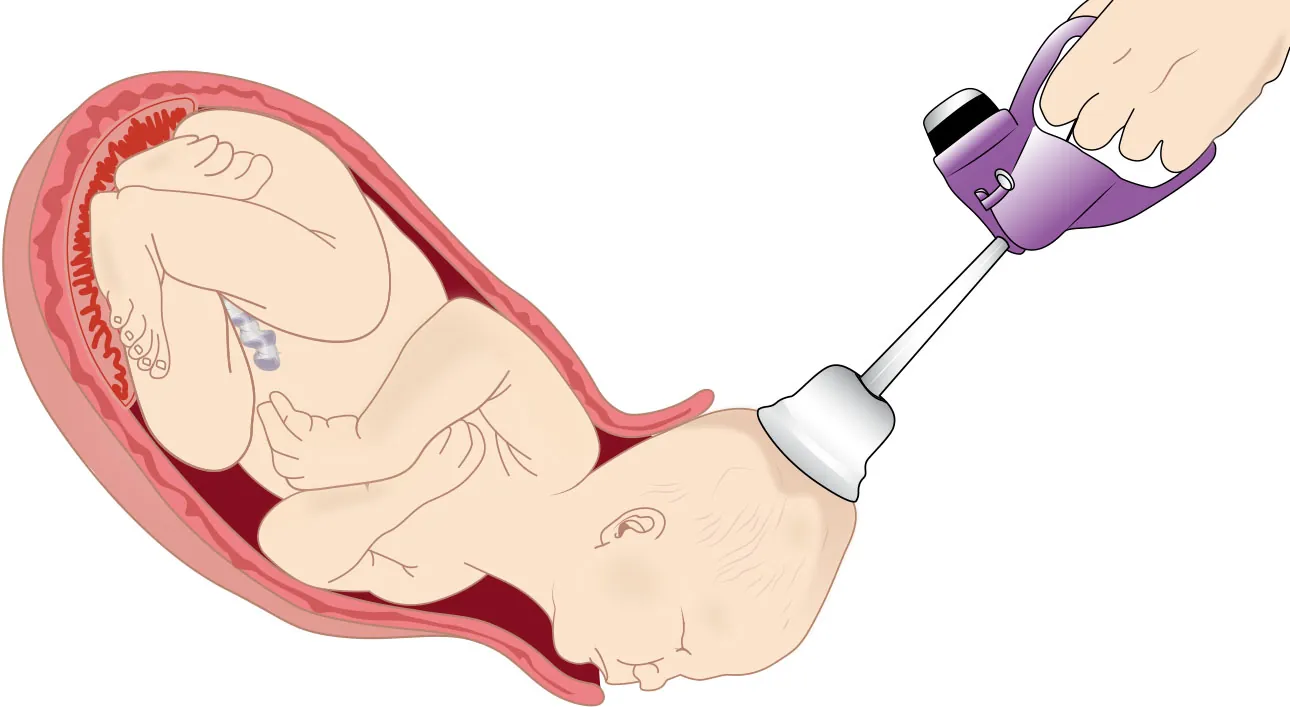 Image of fetus being delivered using a vacuum attached to the head.