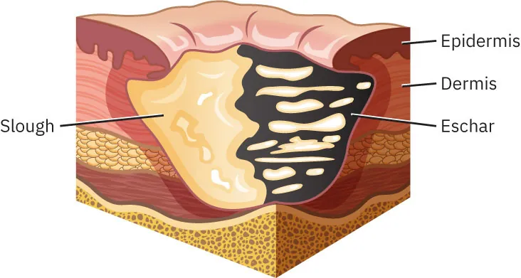 Unstageable pressure injury has both eschar and slough.