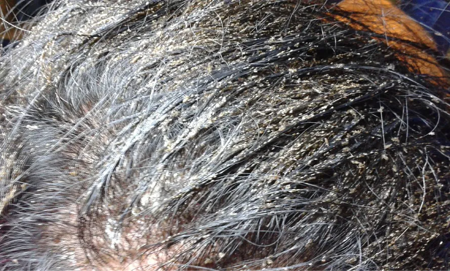Photo of lice nits in a head of hair.