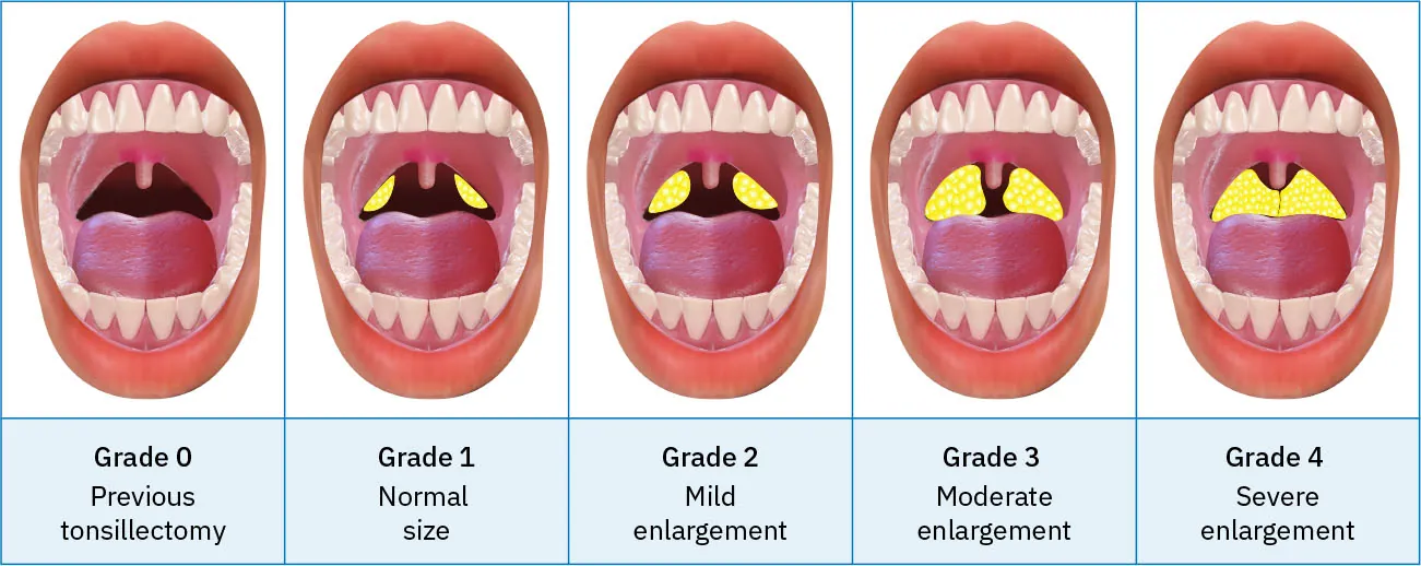 A diagram showing different sizes of tonsils.