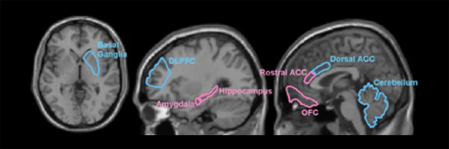 MRIs of adult brain highlighting regions associated with emotion and motivation (amygdala, hippocampus, rostral ACC, OFC) and higher order functions such as working memory and attention (basal ganglia, DLPFC, dorsal ACC, cerebellum). These are brain regions where functional and structural changes are prominent as a result of mistreatment.