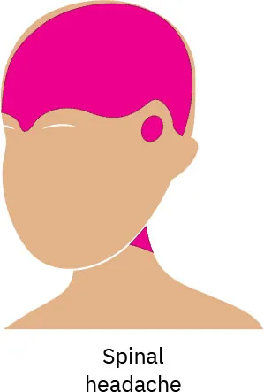 A drawing of a person’s face with a pink highlight on the upper area and back of the neck, showing where spinal pain is reflected.