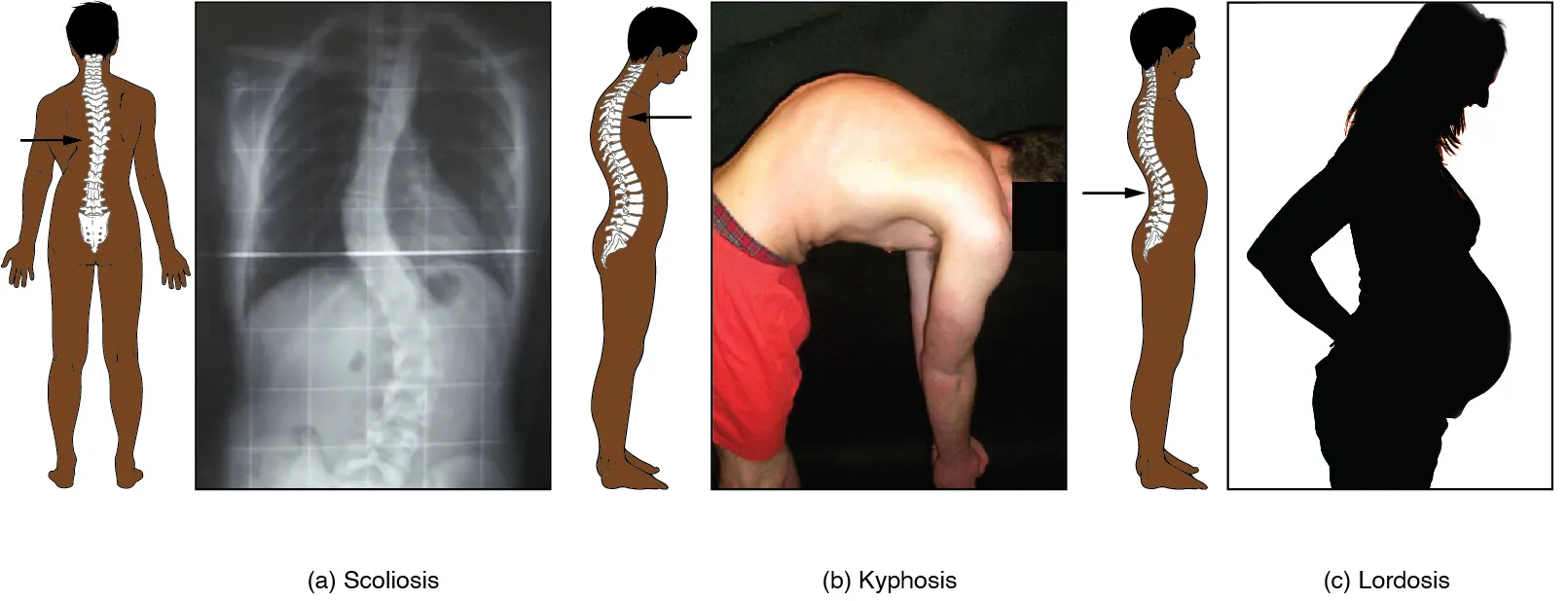This image shows the changes to the abnormal curves of the vertebral columns in different diseases. The left panel shows the change in the curve of the vertebral column in scoliosis, the middle panel shows the change in the curve of the vertebral column in kyphosis, and the right panel shows the change in the curve of the vertebral column in lordosis.