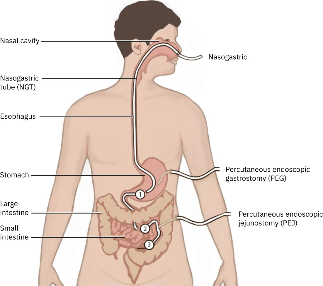 Illustration showing types and placement of commonly used enteral feeding tubes, with labels for Nasogastric, Percutaneous endoscopic gastrostomy (PEG), Percutaneous endoscopic jejunostomy (PEJ), Nasal cavity, Nasogastric tube (NGT), Esophagus, Stomach, Large intestine, and Small intestine.