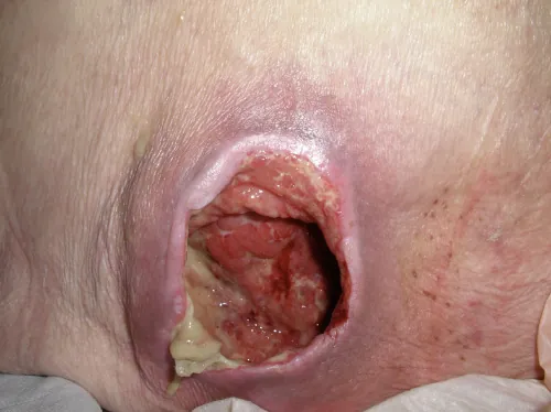 Example of a stage 4 pressure injury.