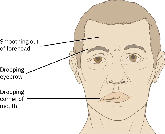 An illustration shows man’s face experiencing Bell’s palsy. The right side of his face is dropping down. It includes the following labels: “Smoothing out of forehead,” “Drooping eyebrow,” “Drooping corner of mouth.”