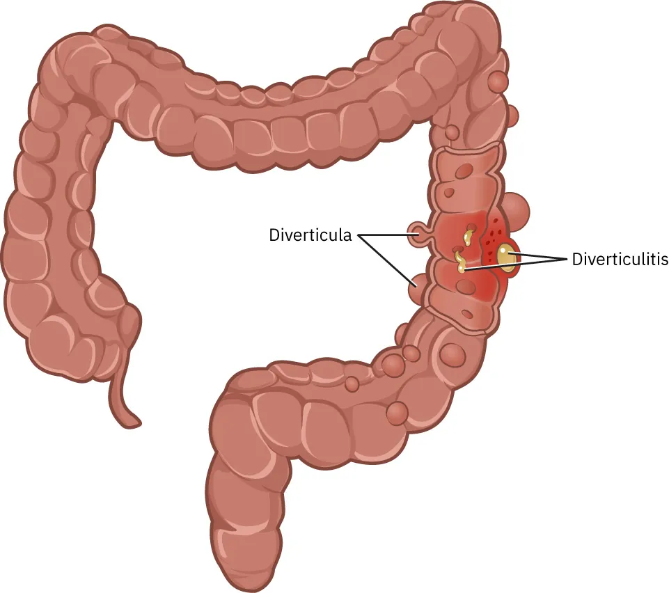 Illustration of large intestine showing diverticulitis, with labels for Diverticula and Diverticulitis.