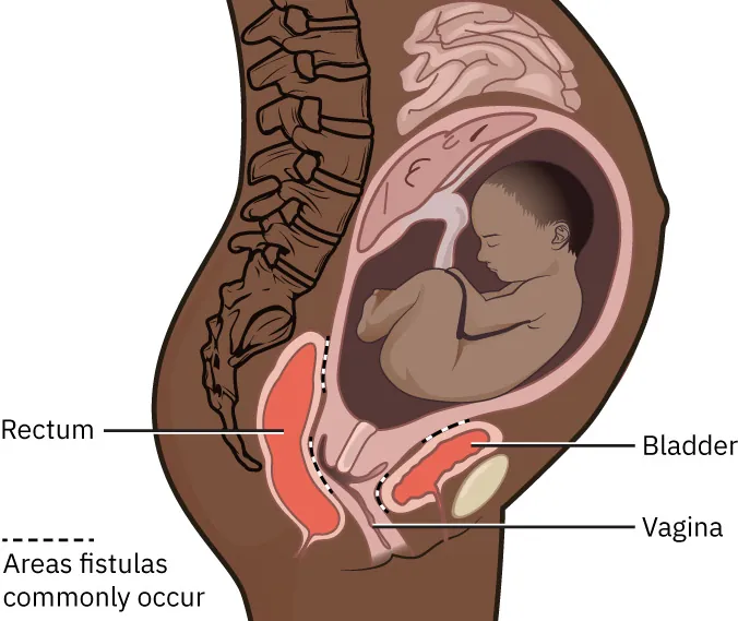 Pregnant person with bladder, vagina, rectum labeled. Common fistula locations – between upper rectum and lower vagina, lower rectum and upper vagina, upper bladder and lower uterus, and upper vagina and lower bladder.