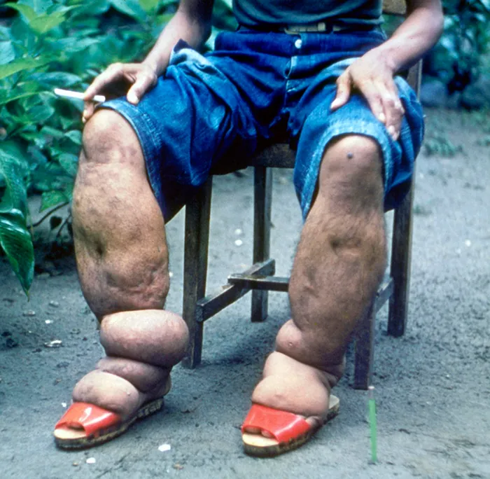 A photo of a person with extremely swollen lower legs.