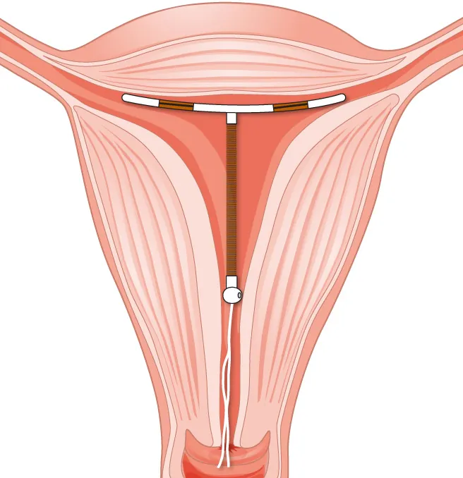 Image of a T-shaped intrauterine device inserted into uterus with string hanging down through the cervix.