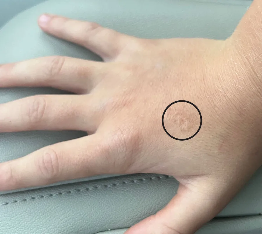 A color photograph shows a hand with a circle around a small scar on the back of the hand.