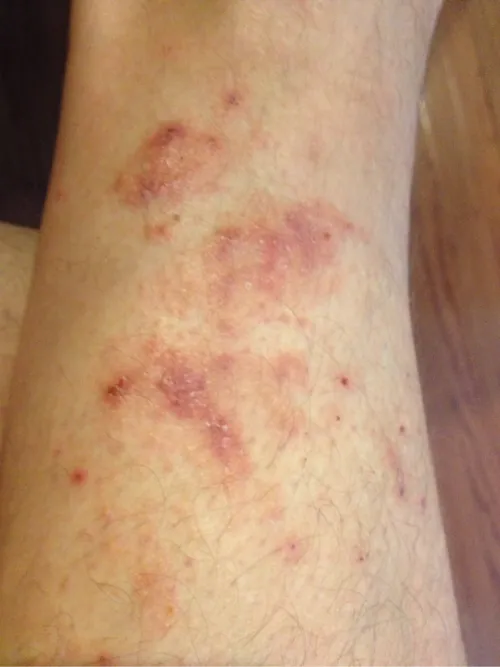 Photo of Contact dermatitis on a limb.
