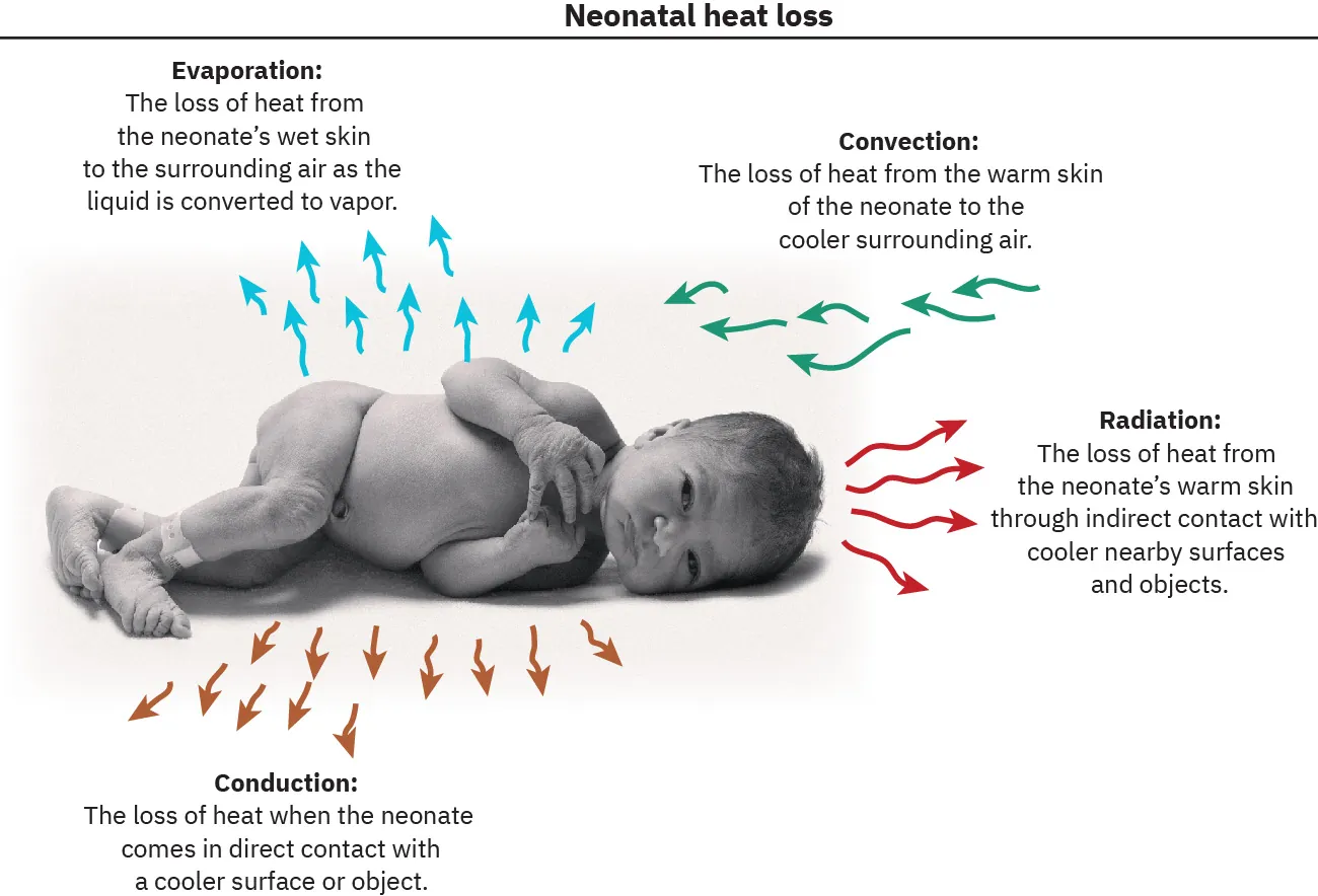 Diagram showing neonatal heat loss: evaporation (the loss of heat from the neonate's wet skin to the surrounding air as the liquid is converted to vapor), convection (the loss of heat from the warm skin of the neonate to the cooler surrounding air), radiation (the loss of heat from the neonate's warm skin through indirect contact with cooler nearby surfaces and objects), and conduction (the loss of heat when the neonate comes in direct contact with a cooler surface or object).