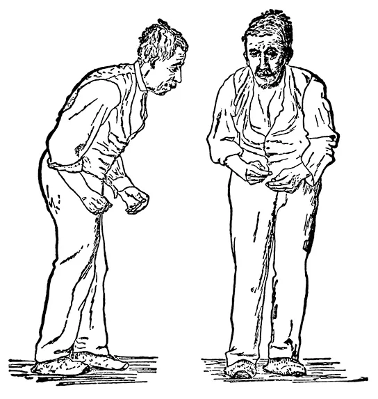 Illustration shows a hunched man with stiff arms and a shuffling walk.