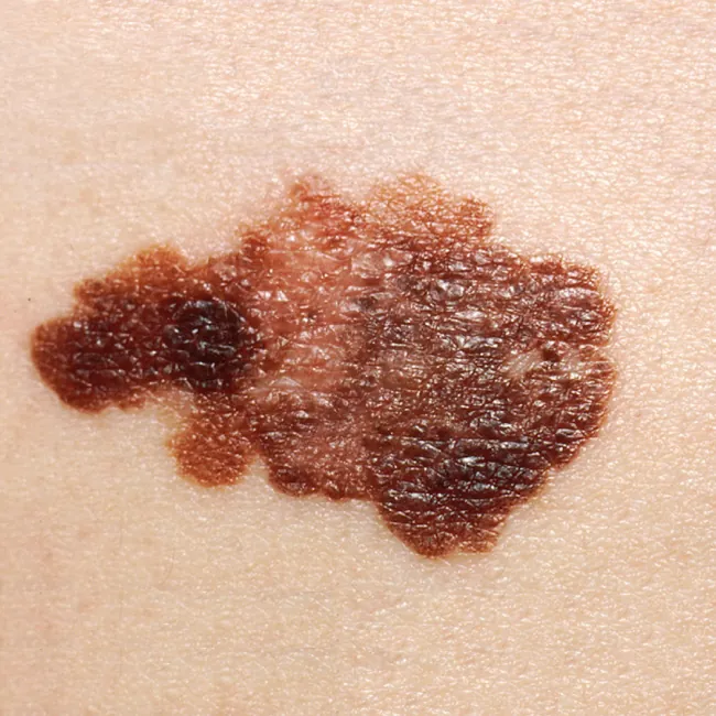 Photo of a melanoma cancer on a body part.