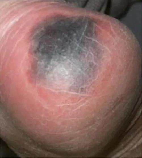 A photograph of a patient’s heel showing deep tissue injury, with a deep-purple, blood-filled appearance.