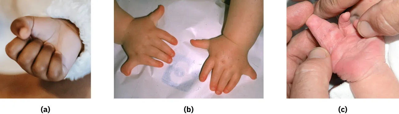 Images of three infant hands: a hand with all five fingers, a hand with extra pinkies at 90° angles sticking out from hand, and hand with three fingers fused together.