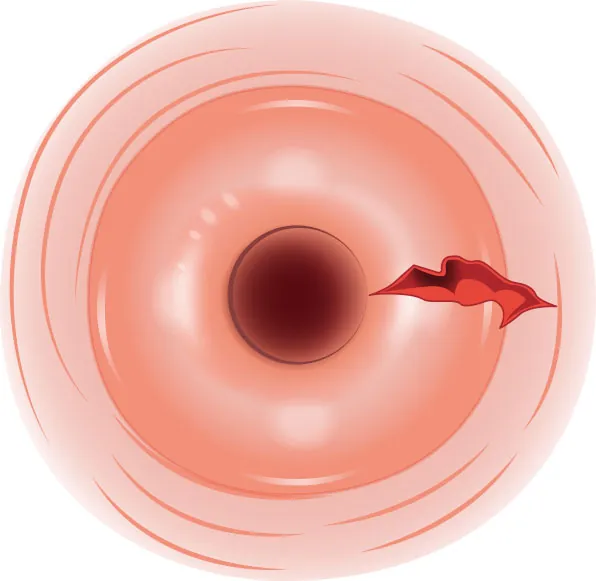 Image of cervix with a laceration at the right side.