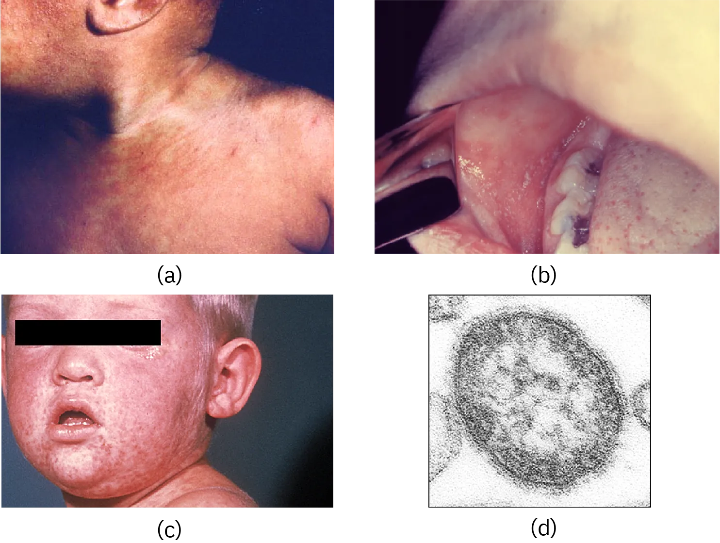 a and b) Red bumps on a children's faces. c) Red spots inside the mouth. d) A micrograph of an oval structure containing a scale bar measuring 50 nanometers.