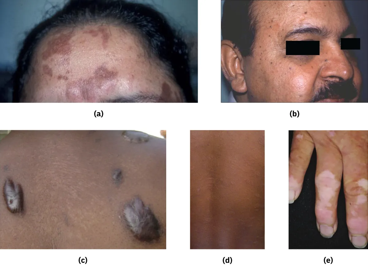 A collage of color photographs show (a) postinflammatory hyperpigmentation, (b) dermatosis papulosa nigra, (c) keloids, (d) pityriasis, and (e) vitiligo.