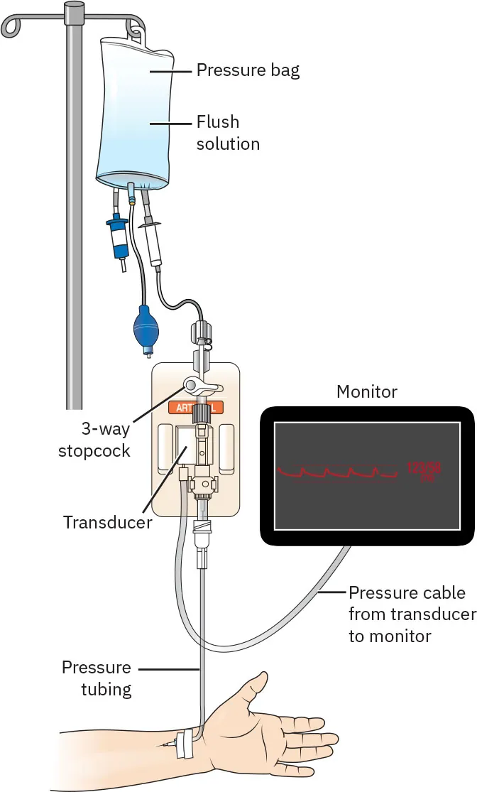 Arterial line blood pressure monitoring setup showing pressure bag, flush solution, 3-way stopcock, transducer, pressure tubing, pressure cable from transducer to monitor, monitor.