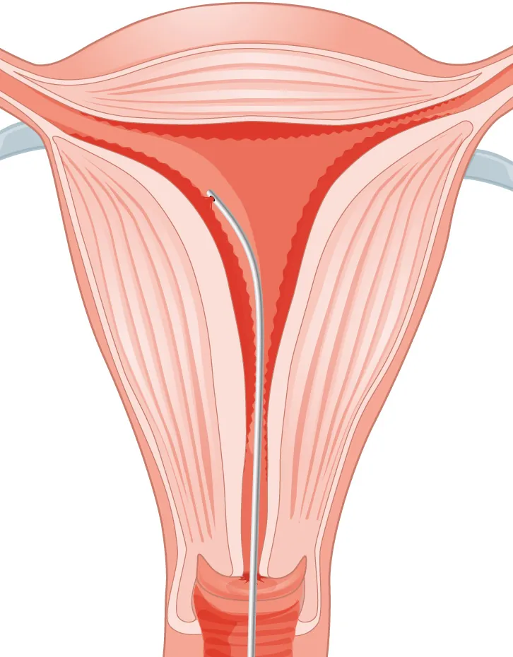Image of a long biopsy tool being inserted into the uterus through the vagina and cervix and collecting cells from inside the uterus.