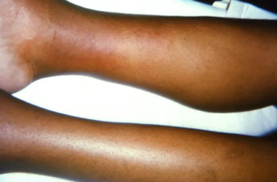A photograph shows two lower legs. The right lower leg is swollen, and erythematous around the ankle region.