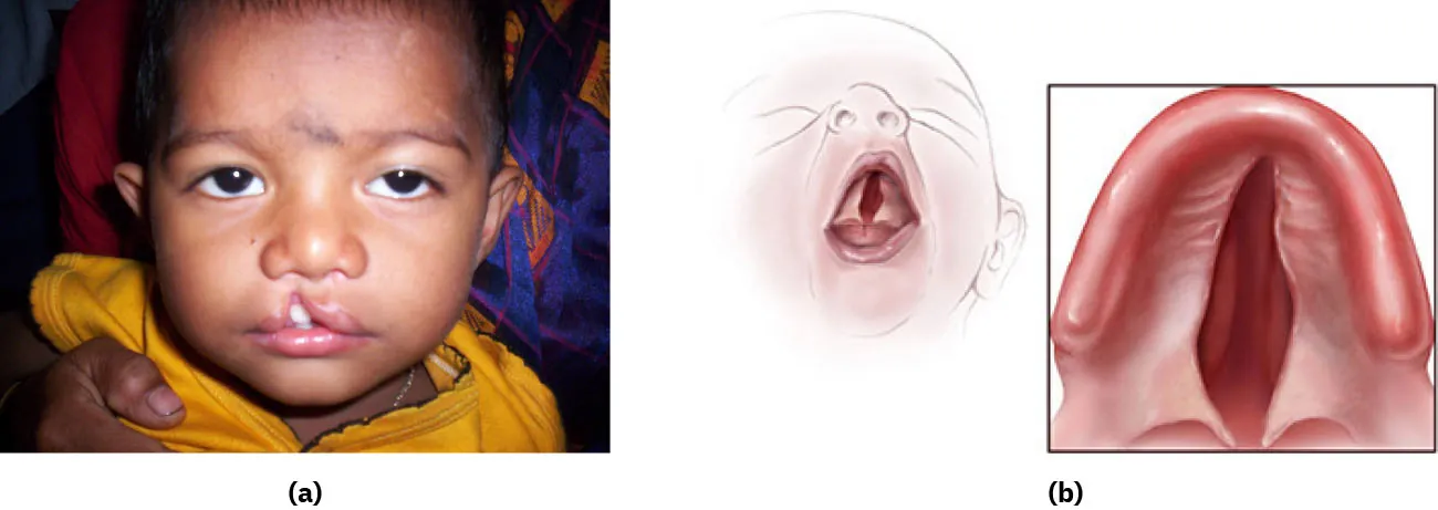 On the left, a photo of a child with a cleft lift. On the right, an image of a cleft palate.