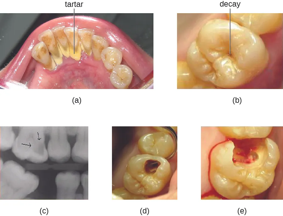A) photo of a tooth with a dark spot labeled decay. B) micrograph of a tooth; dark regions have an arrow. C) photo of a tooth with a hole. D) photo of a tooth with a large, bleeding hole