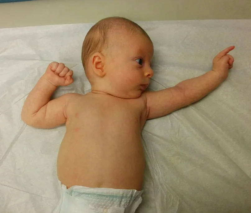 Photo of infant facing to the left with left arm extended out, while right arm is bent at the elbow and the fist is close to the shoulder.